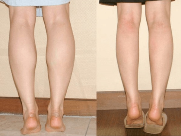 Nguyên nhân hình thành bắp chân to? Cách giảm mỡ bắp chân hiệu quả và an toàn