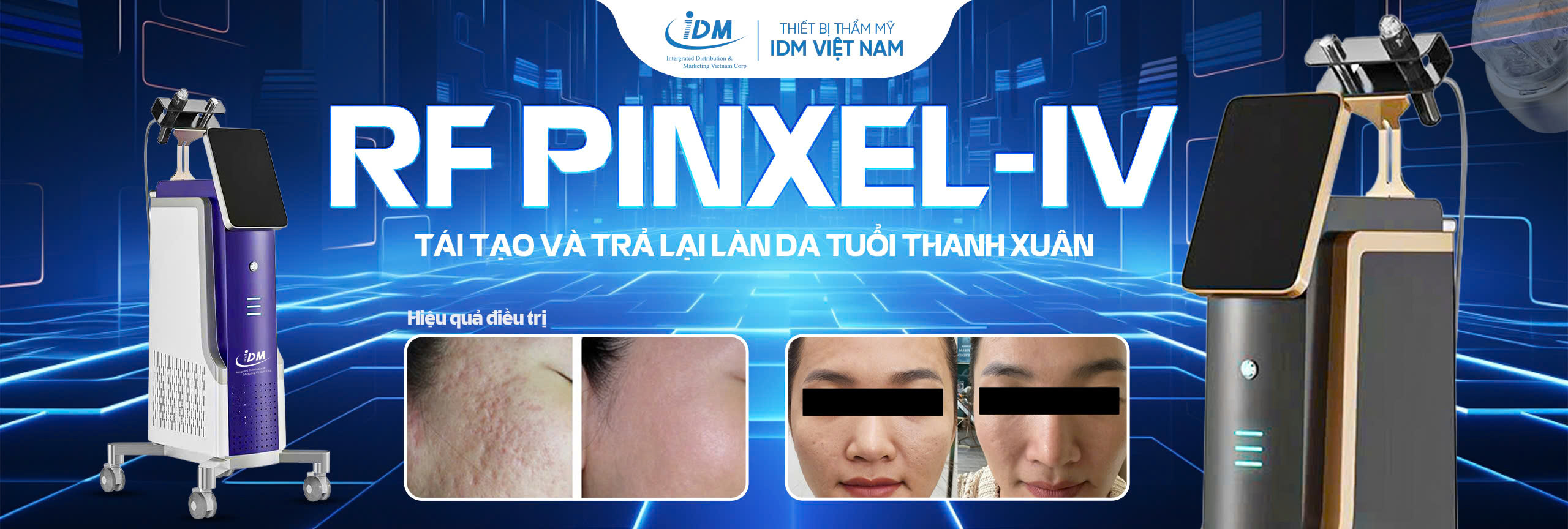 Công nghệ RF vi điểm