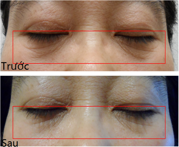 Nếp nhăn vùng mắt giảm rõ rệt sau khi điều trị với Hifu FU4.5-10