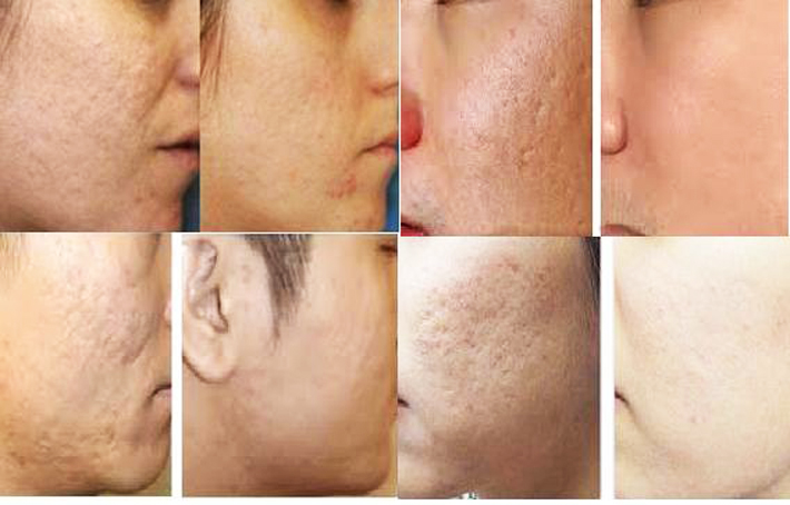 RF Microneeling: Tiêu chuẩn mới trong điều trị sẹo rỗ và trẻ hoá da