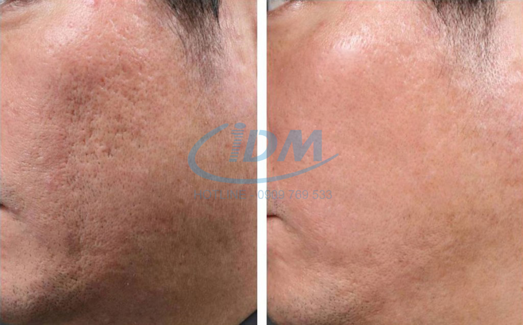 Hiệu quả trước và sau khi điều trị bằng trị sẹo Skin Xel